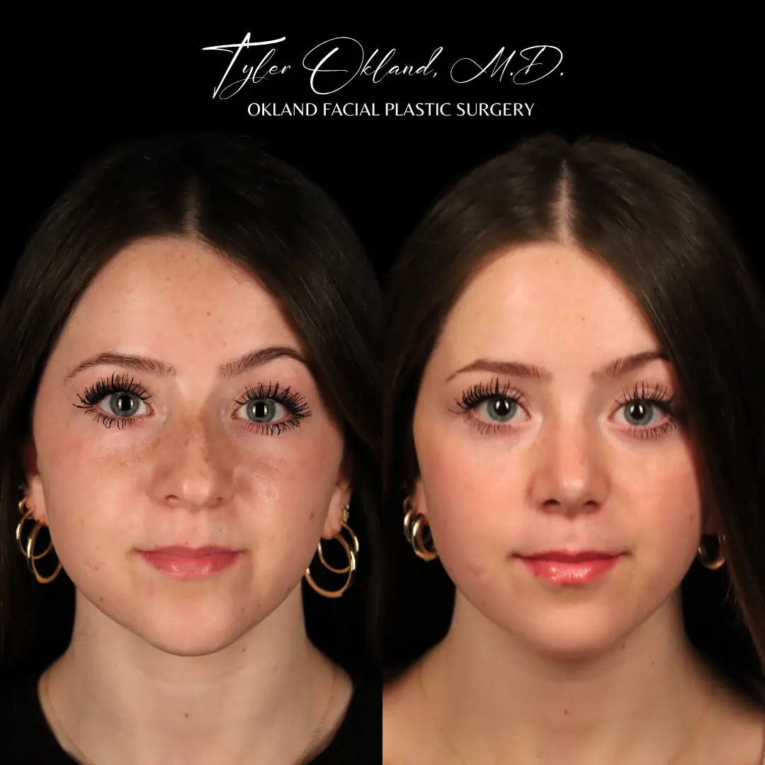 Frontal before and after primary rhinoplasty result for a 20-year-old female treated by Dr. Tyler Okland in Denver