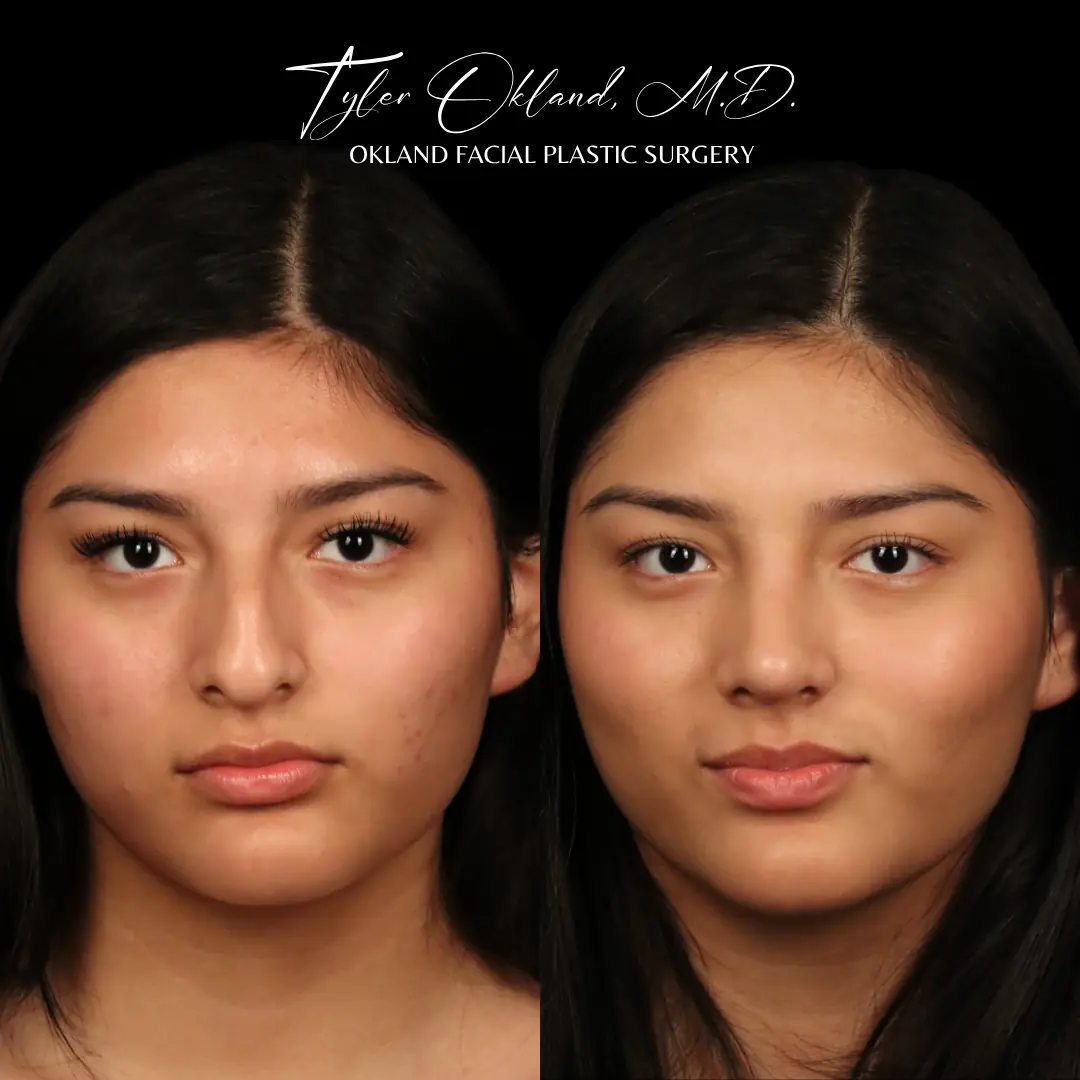 Frontal before and after primary rhinoplasty result for an 18-year-old female treated by Dr. Tyler Okland in Denver