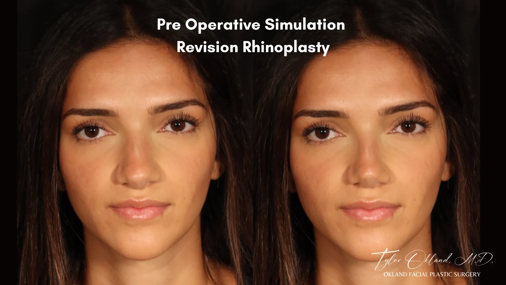 Case 1: Rebuilding Tip Support With Autologous Rib Cartilage revision rhinoplasty case image 3