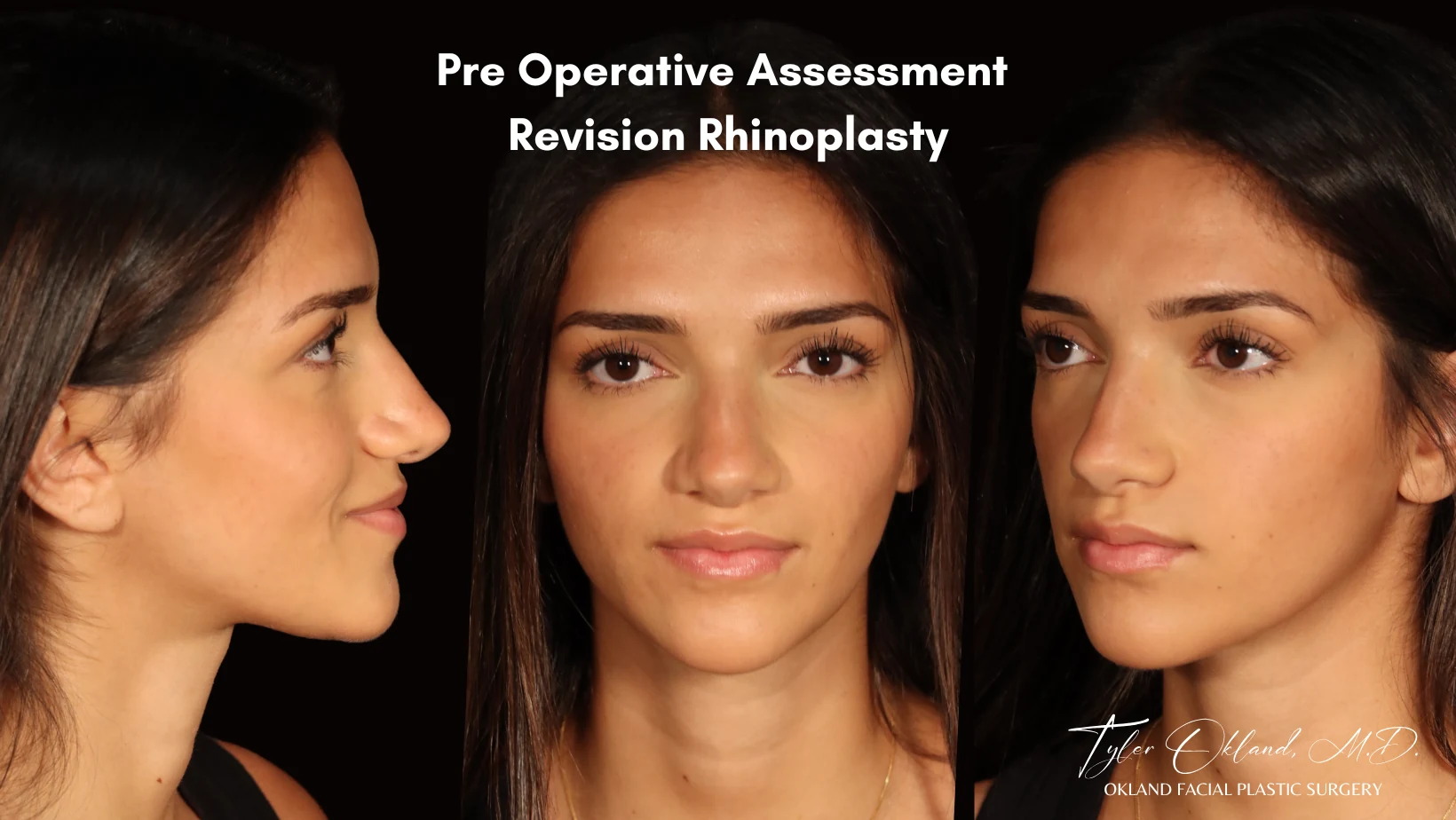 Case 1: Rebuilding Tip Support With Autologous Rib Cartilage revision rhinoplasty case image 1