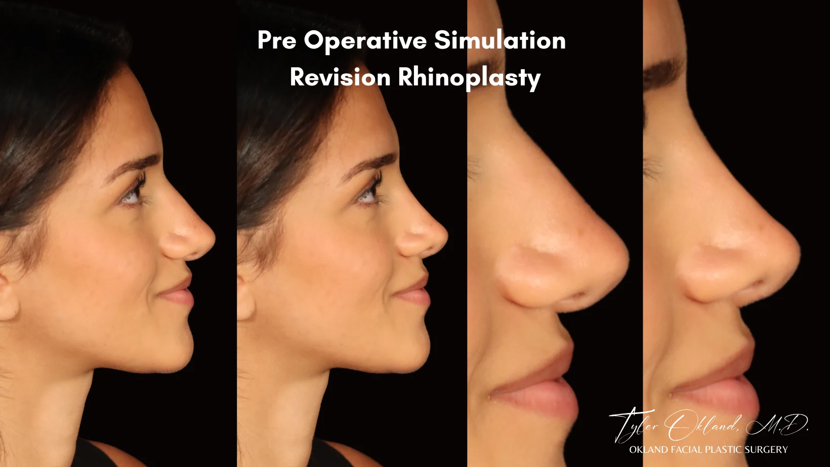 Case 1: Rebuilding Tip Support With Autologous Rib Cartilage revision rhinoplasty case image 2