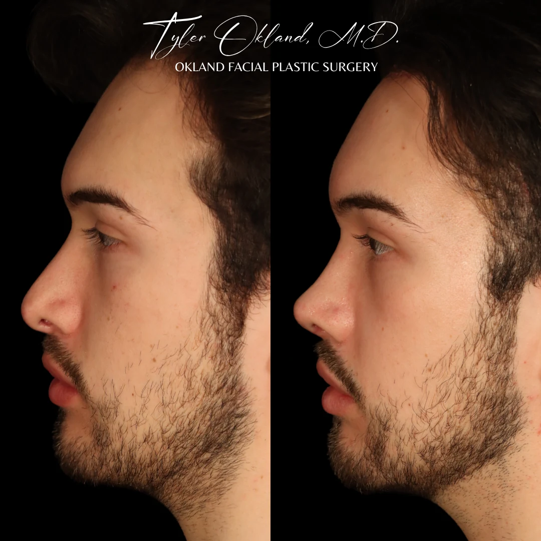 Case 2: Rebuilding an Over-Resected Tip and Correcting an Inverted-V Deformity revision rhinoplasty case image 4