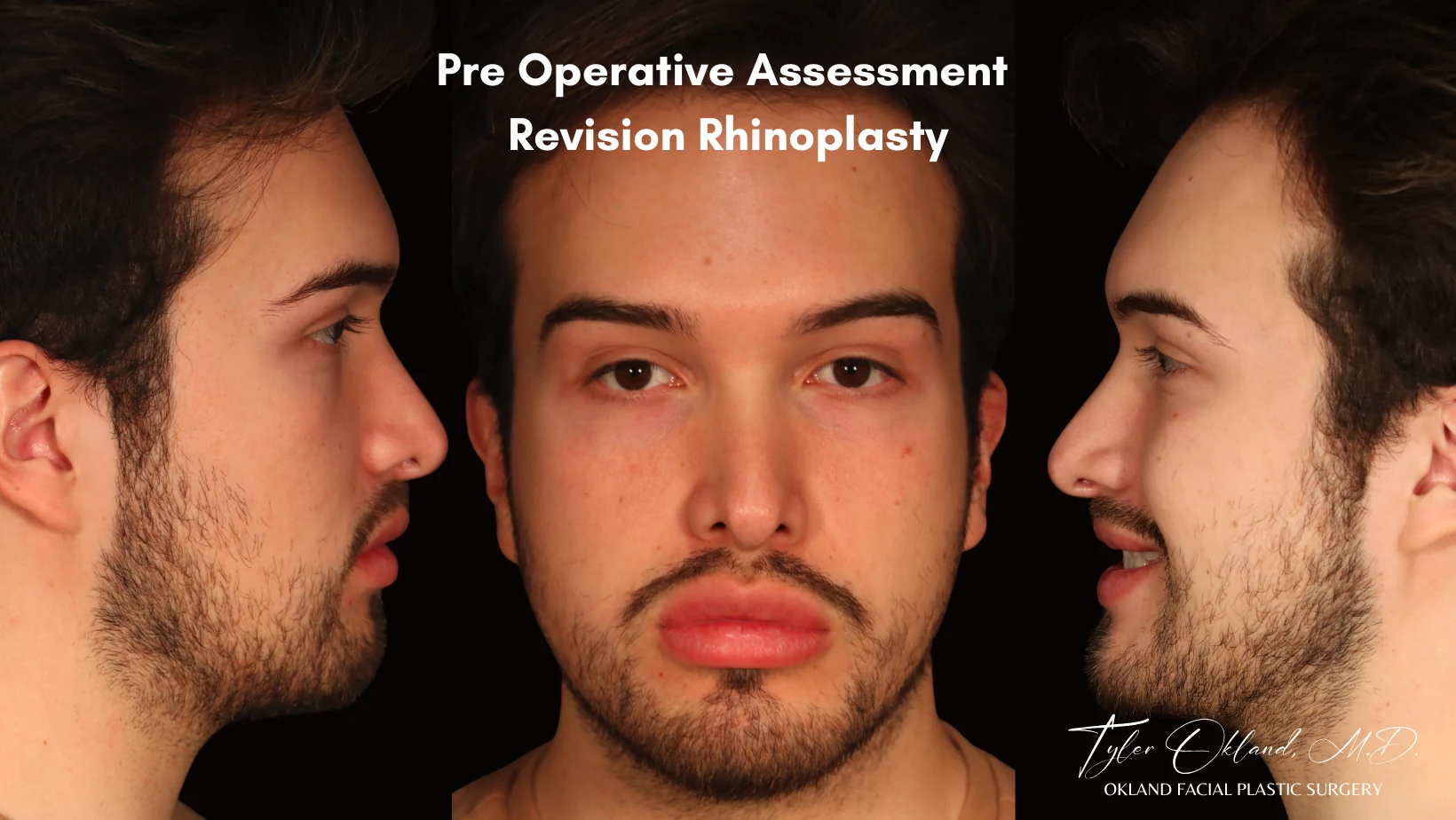 Case 2: Rebuilding an Over-Resected Tip and Correcting an Inverted-V Deformity revision rhinoplasty case image 1