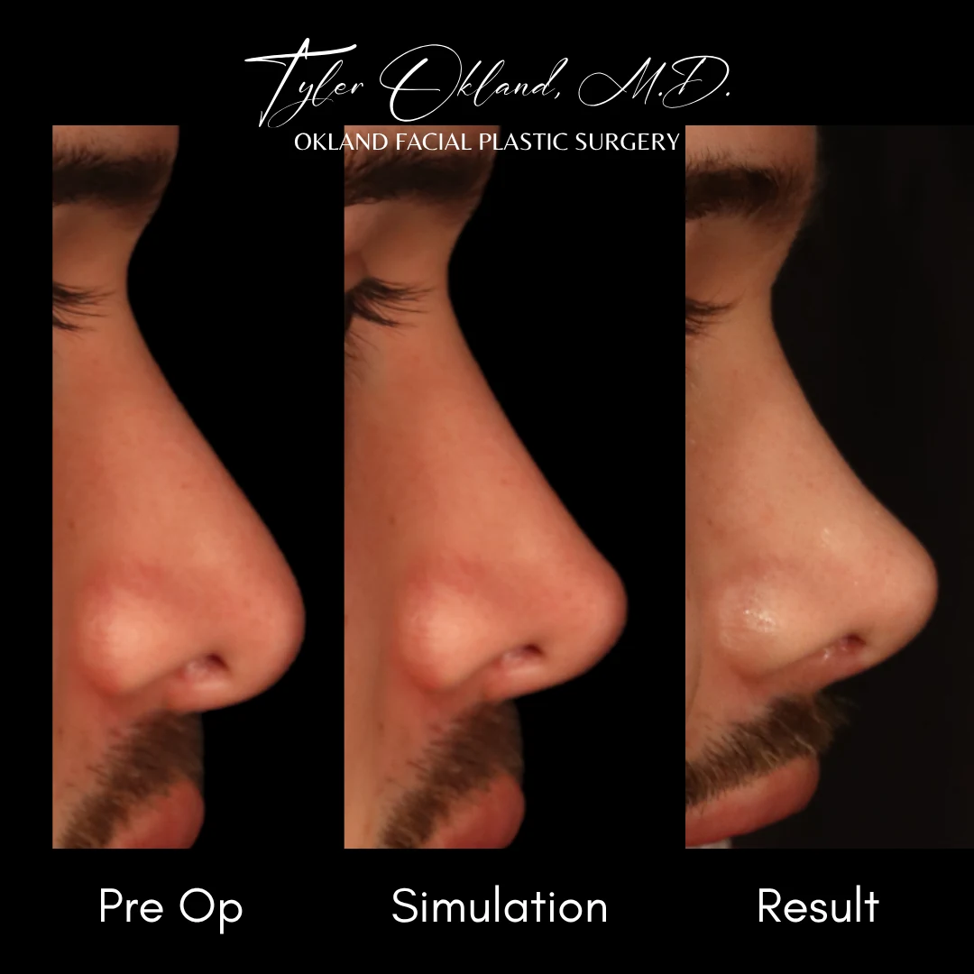 Case 2: Rebuilding an Over-Resected Tip and Correcting an Inverted-V Deformity revision rhinoplasty case image 3