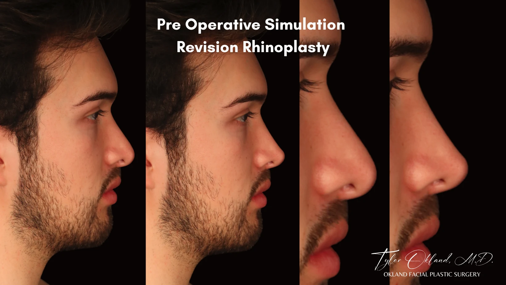 Case 2: Rebuilding an Over-Resected Tip and Correcting an Inverted-V Deformity revision rhinoplasty case image 2