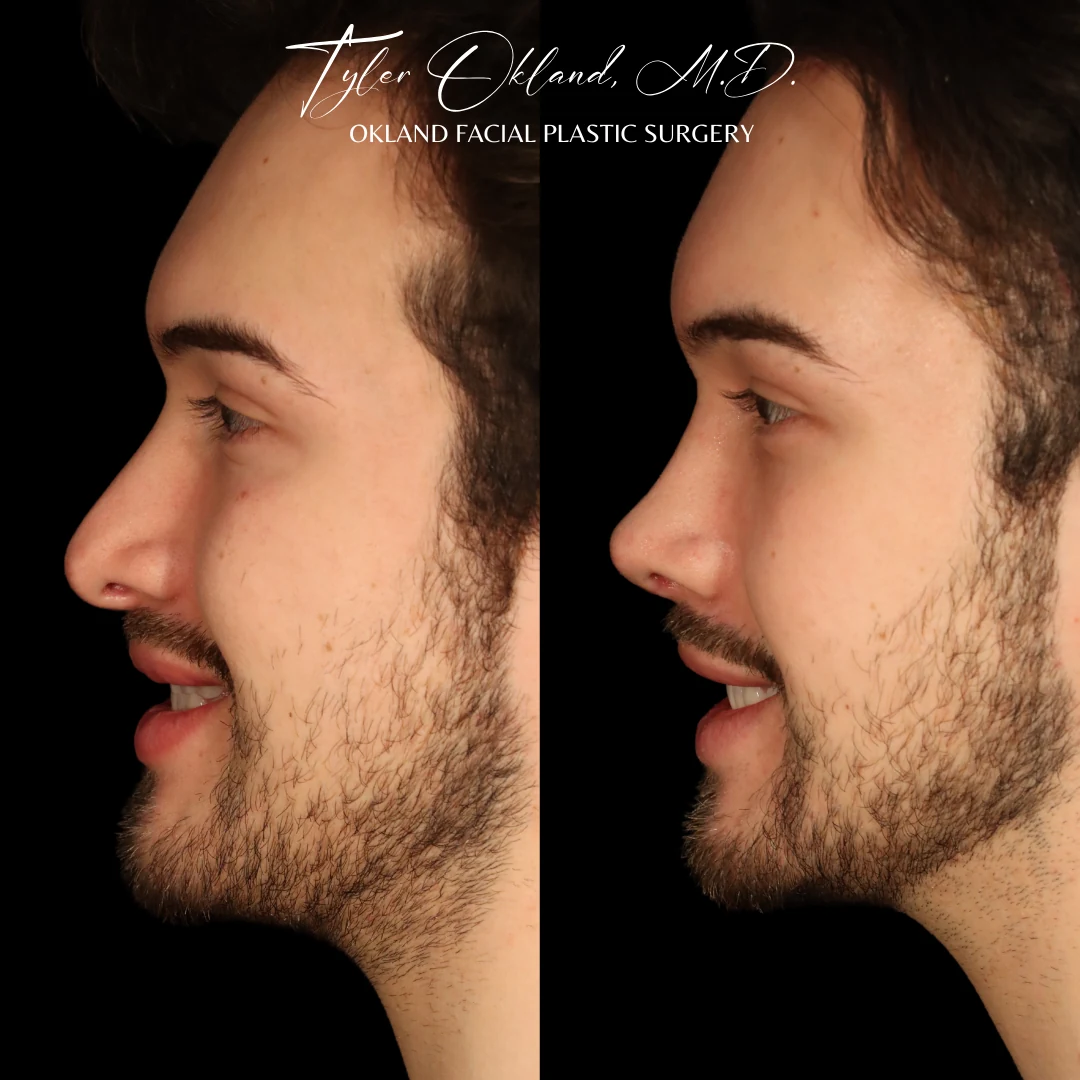 Case 2: Rebuilding an Over-Resected Tip and Correcting an Inverted-V Deformity revision rhinoplasty case image 5