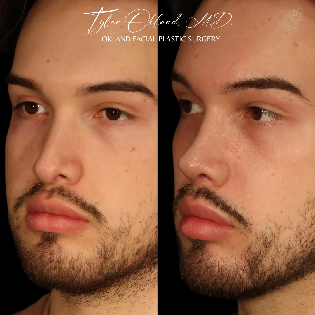 Case 2: Rebuilding an Over-Resected Tip and Correcting an Inverted-V Deformity revision rhinoplasty case image 6