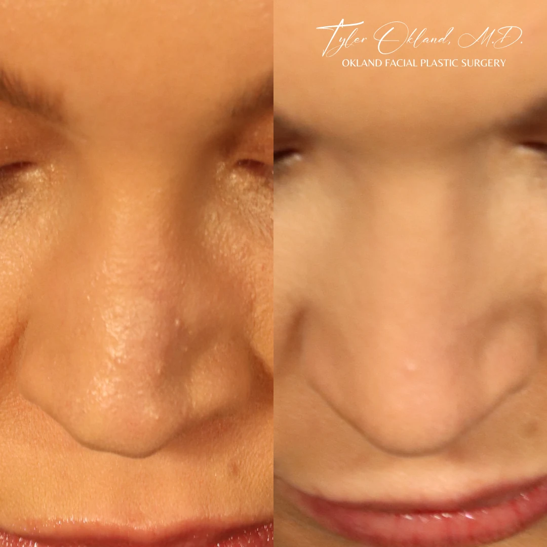 Reconstructive Case With Revision-Level Complexity: Rebuilding a Collapsed Saddle Nose revision rhinoplasty case image 5