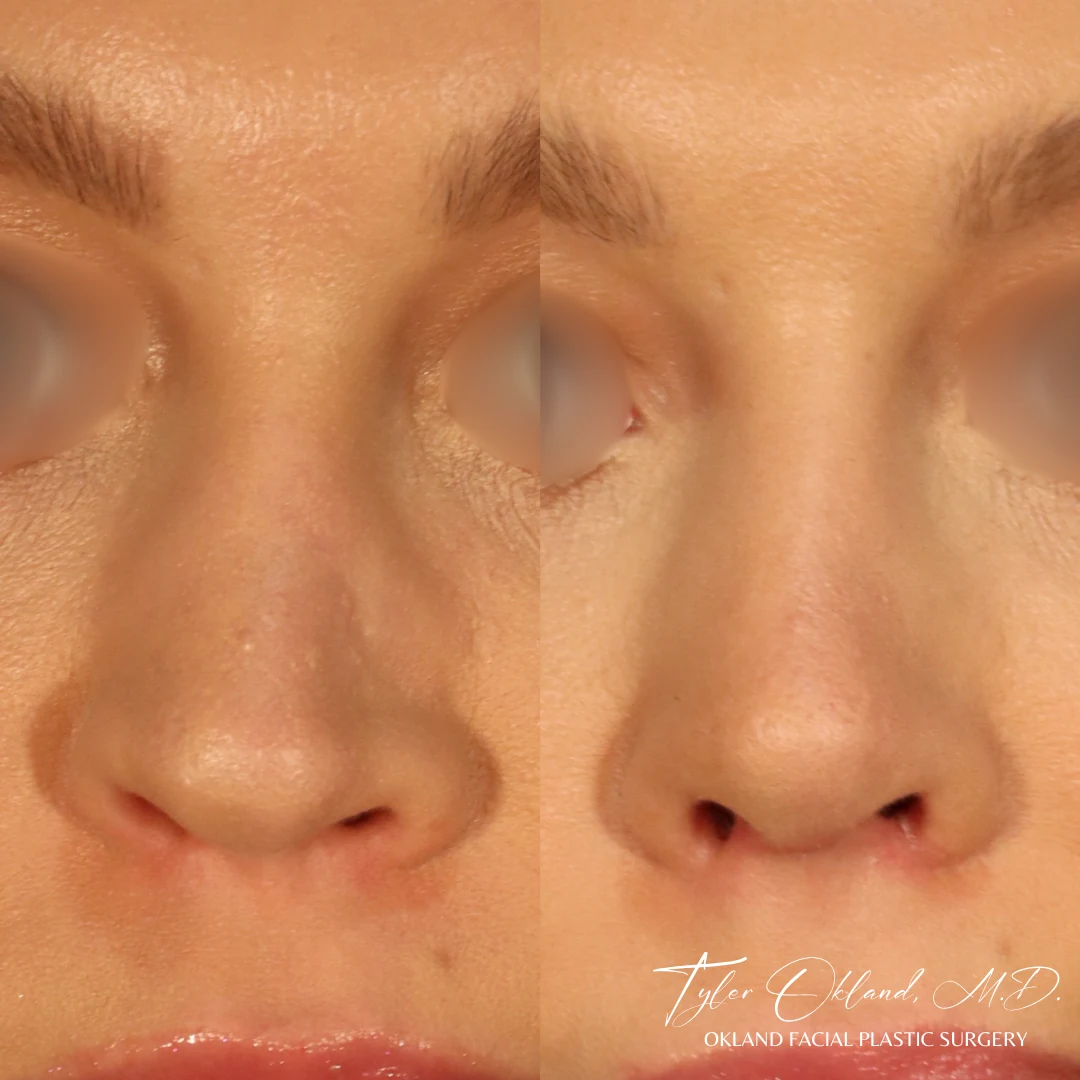 Saddle-nose reconstruction with rib cartilage — view 3