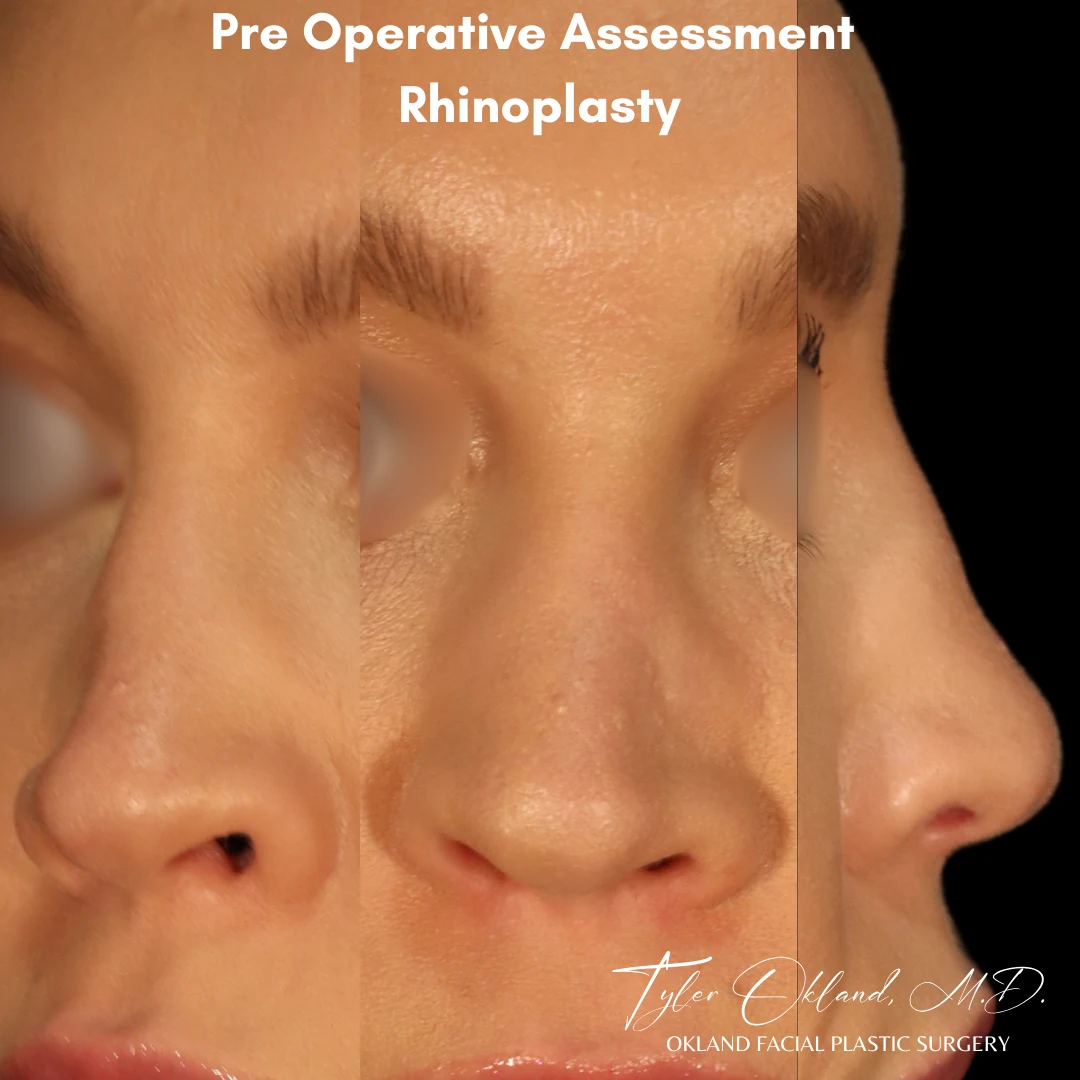 Reconstructive Case With Revision-Level Complexity: Rebuilding a Collapsed Saddle Nose revision rhinoplasty case image 1