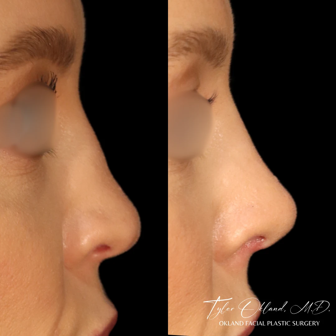 Saddle-nose reconstruction with rib cartilage — view 1