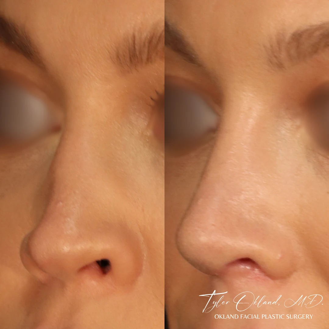 Saddle-nose reconstruction with rib cartilage — view 2