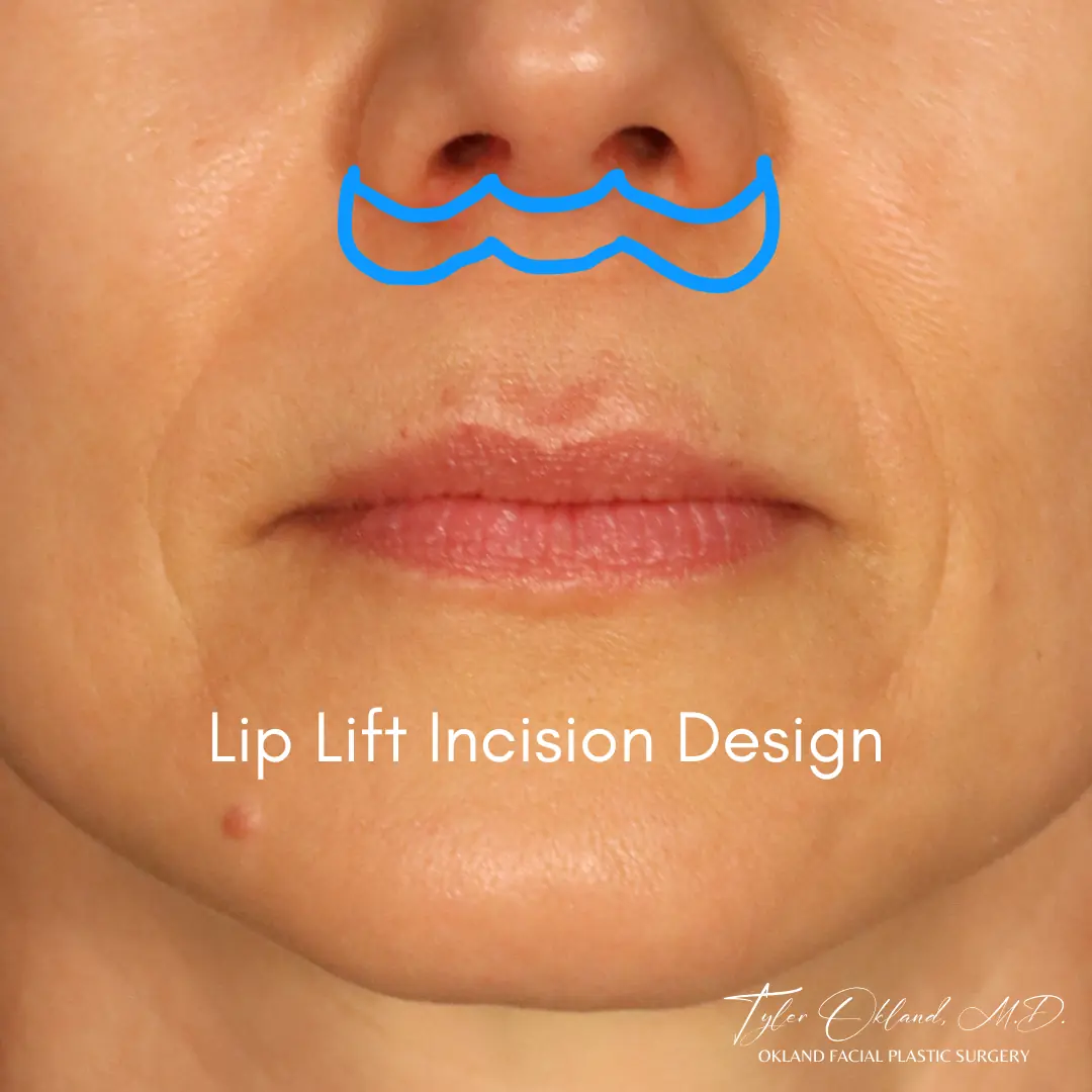 Lip Lift Incision Design