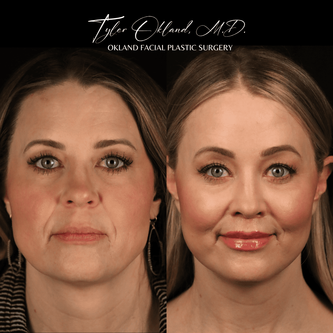 Before and after extended deep plane facelift and facial rejuvenation by Dr. Tyler Okland in Denver, case 01